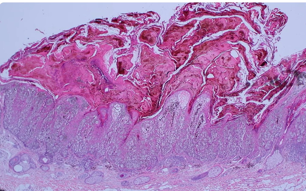 Melanoma