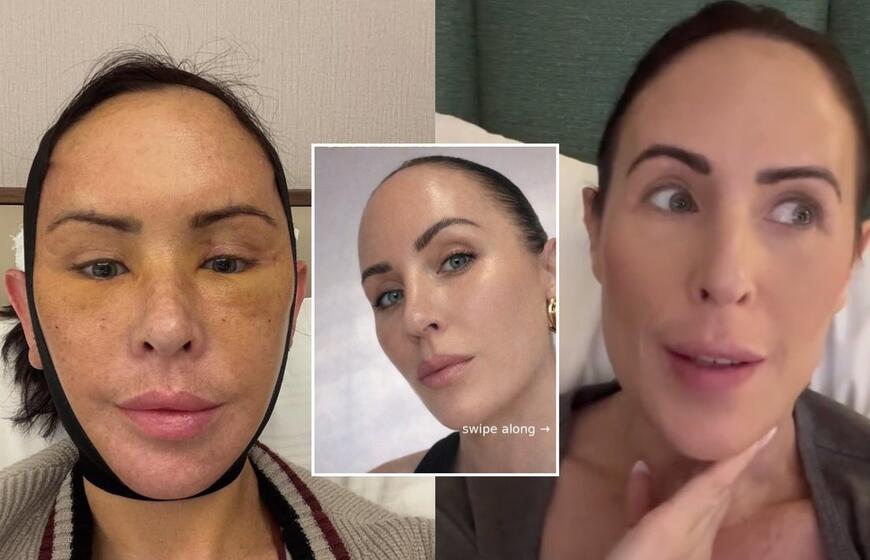 Moteris tikėjosi atjaunėti Turkijos chirurgų pagalba