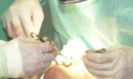 Audinių inžinerijos technologijos pritaikytos operuojant paauglius