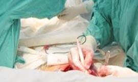 Amerikietei išoperuotas 64 kg svėręs auglys