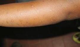 Uzbekijos ligoninėje per 40 vaikų užkrėsti ŽIV