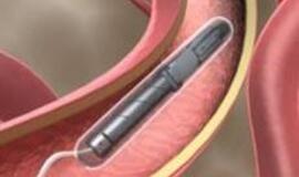 Prieš vėžį – povandeniniais laivais