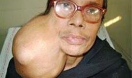 Medikai pacientei nuo veido pašalino kamuolio dydžio auglį