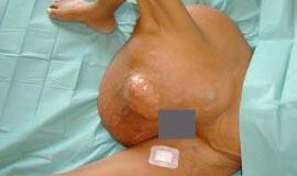 Moteriai pašalintas 18 kg auglys