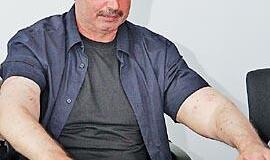 Sėkmingai transplantuojamos ir rankos