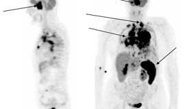 Pasaulinė limfomos žinomumo diena - ir Lietuvoje