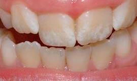 Atlikti dantų fluorozės tyrimai