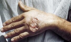 Afganistane - odą bjaurojančios ligos epidemija