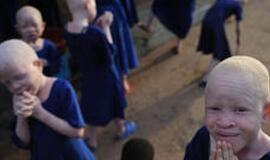Burundyje ritualinės žmogžudystės auka vėl tapo albinosas berniukas