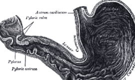 Skrandžio mažinimo operacija gali išgydyti antro tipo diabetą