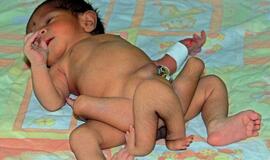 Pakistane sėkmingai operuotas su šešiomis kojomis gimęs kūdikis