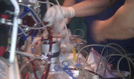 Pacientas pervežtas panaudojus „dirbtinius plaučius“