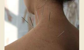Akupunktūros specialistas pamiršo adatėlėmis prismaigstytą pacientę