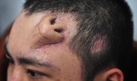 Kinų medikai užaugino nosį ant vyro kaktos