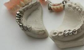 Senovės keltai galėjo turėti dantų implantus