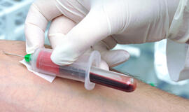 Lėtinės mieloleukemijos diagnozę kasmet išgirsta apie 30 mūsų šalies gyventojų