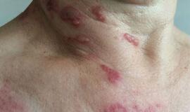 Juostinė pūslelinė - ne juokai