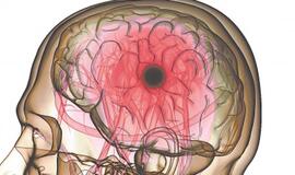 Minima Pasaulinė insulto diena: Lietuvoje nuo jo kasmet miršta apie 2,5 tūkst. žmonių