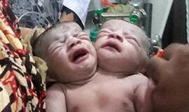 Bangladeše gimė dvigalvė mergaitė