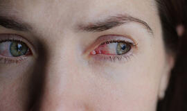 Susirūpinkite, jei ryte akys raudonos