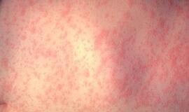 Raudonuke susirgti gali tiek vaikai, tiek suaugę: liga ypač pavojinga nėščiosioms