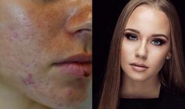 Specialistai: nesprendžiamos odos problemos sukelia psichologinių sunkumų, gali trukdyti siekti karjeros