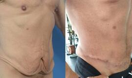 Pilvo plastika vyrams preso nepadovanos, bet formas sugrąžins