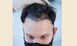 Plinkantis Vaidas Baumila ryžosi plaukų transplantacijai
