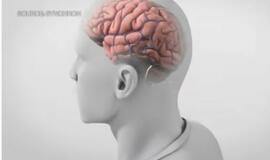  JAV į žmogaus smegenis implantuota pirmoji neurologinė mikroschema