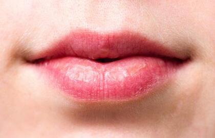Išsausėjusios ir skilinėjančios lūpos – dažna problema žiemą. Kaip ją spręsti?
