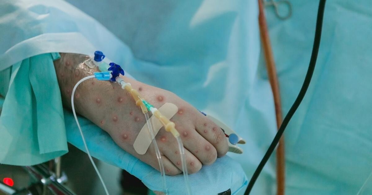 NVSC: Lietuvoje patvirtintas pirmas B raupų atvejis šiemet