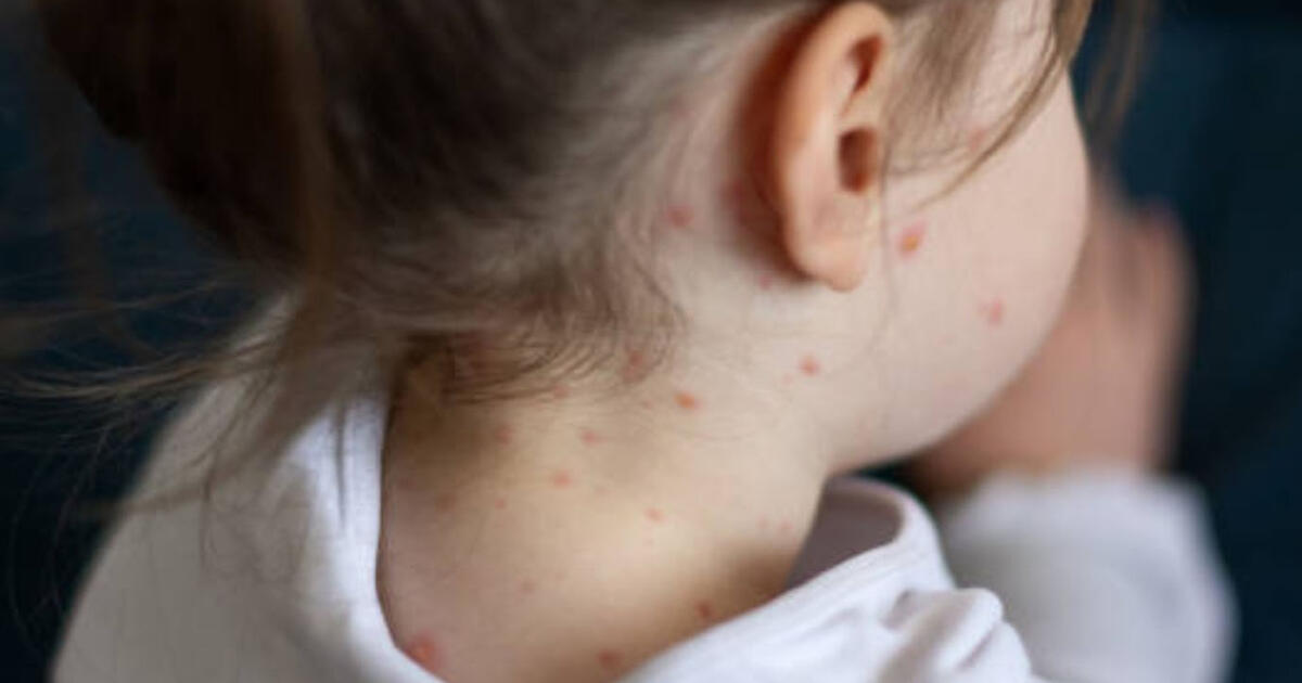 Į Kanadą sugrįžo tymai