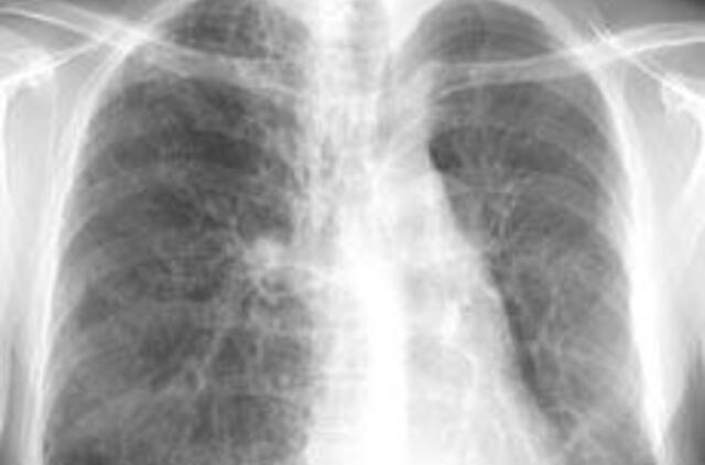 Atlikta trečioji plaučių transplantacija Lietuvoje