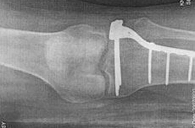 Pasaulinės osteoporozės dienos proga – dovana pacientams