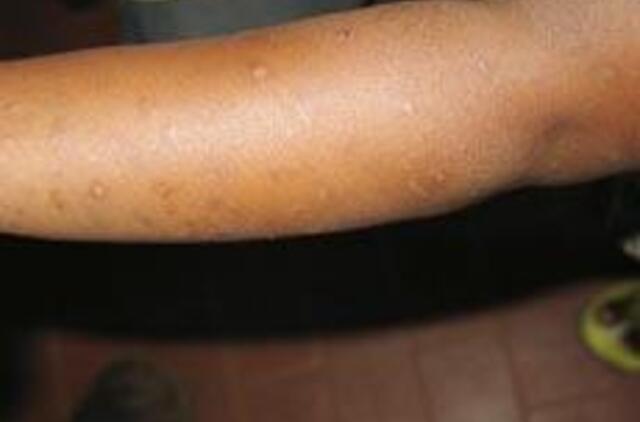 Uzbekijos ligoninėje per 40 vaikų užkrėsti ŽIV