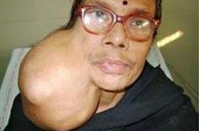 Medikai pacientei nuo veido pašalino kamuolio dydžio auglį