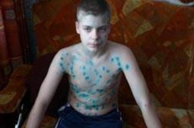 Vėjaraupiais geriau sirgti vaikystėje