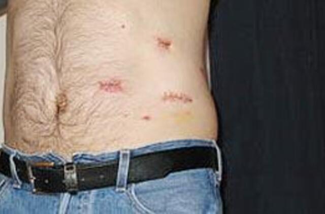 Pasaulinė inkstų diena bus pažymėta konferencija Klaipėdoje