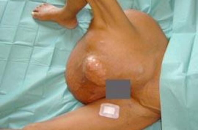 Moteriai pašalintas 18 kg auglys