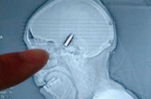 Moteris 42 metus gyveno su kulka galvoje