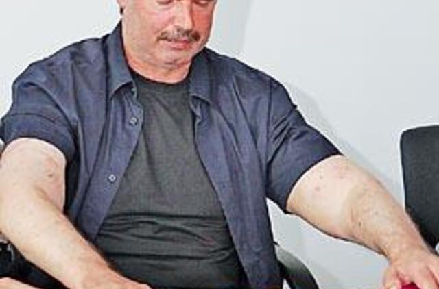 Sėkmingai transplantuojamos ir rankos