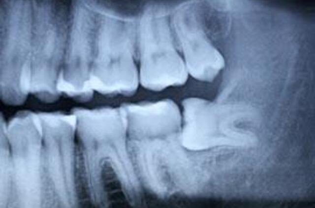 Paauglei išdygo 33 papildomi dantys