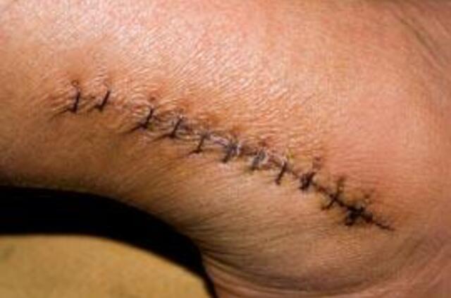 Mokslininkai krevečių lukštuose aptiko raktą į žaizdų gijimą be randų