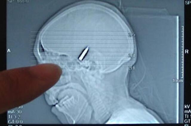 Rusas 66 metus gyvena su kulka galvoje