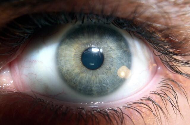 Nors gyventojų Lietuvoje mažėja, sunkių akių traumų - ne