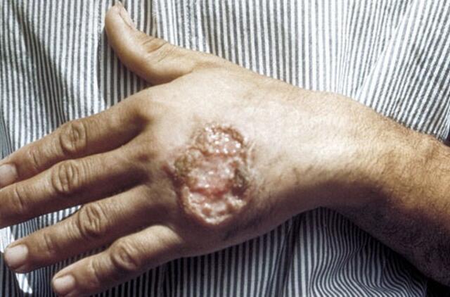 Afganistane - odą bjaurojančios ligos epidemija