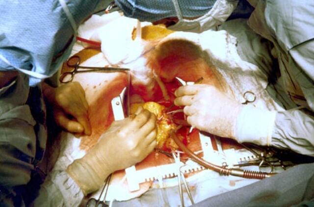 Egipte medikai vaikui pašalino 7 kg auglį