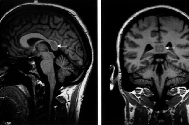 Medikė: epilepsija neturi įtakos vairavimo kokybei ir saugumui