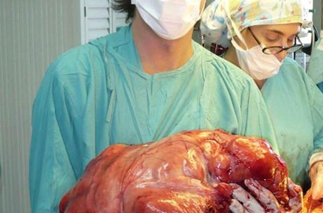 Hondūrietei iš pilvo pašalintas 16 kg auglys