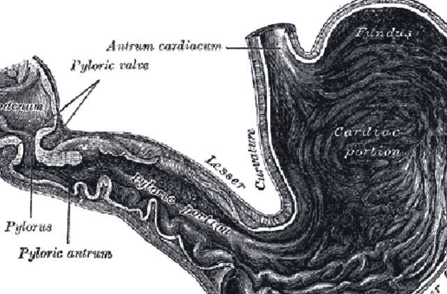 Skrandžio mažinimo operacija gali išgydyti antro tipo diabetą
